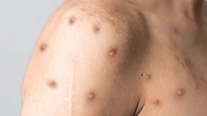 Experts emphasize that monkeypox poses a risk to any ethnicity or nation.