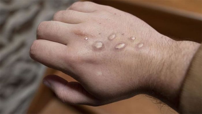 Monkeypox