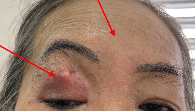 A patient admitted to Cho Ray Hospital with symptoms of headache, swollen eye, and swollen forehead on the right.