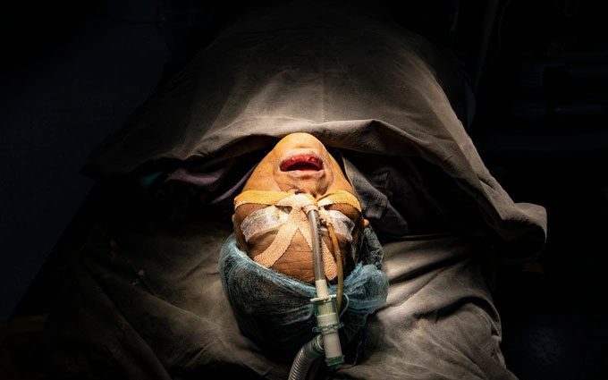A patient recovering after surgery due to a fungal infection.