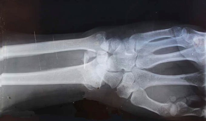 X-ray image of a person's arm and hand.