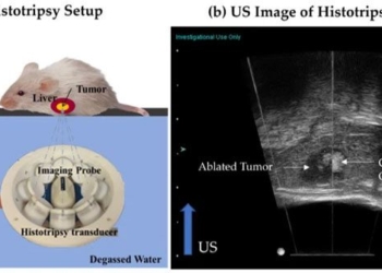 breaking a ultrasound technology that helps eliminate liver tumors without surgery 120132