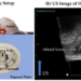breaking a ultrasound technology that helps eliminate liver tumors without surgery 120132