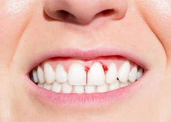 causes of gum disease 4621