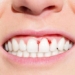 causes of gum disease 4621