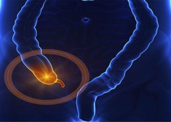 causes symptoms and treatment of umbilical hernia 119822
