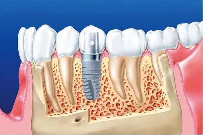 Professor Per Ingvar Branemark discovered the implant grafting material made of Titanium in 1952.