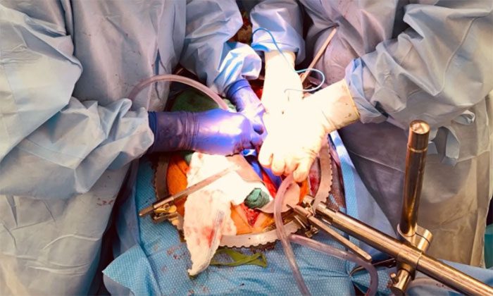 Pig kidney transplant for brain-dead recipient