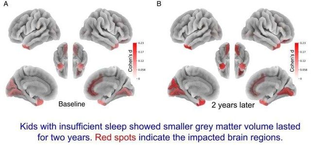 Children sleeping less than 9 hours a night have less gray matter.