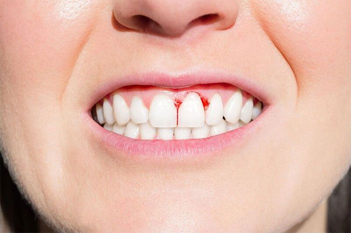 Gingivitis can lead to easy bleeding of the gums.