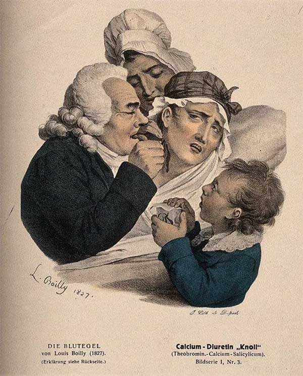 A doctor using leeches to draw blood from a patient.