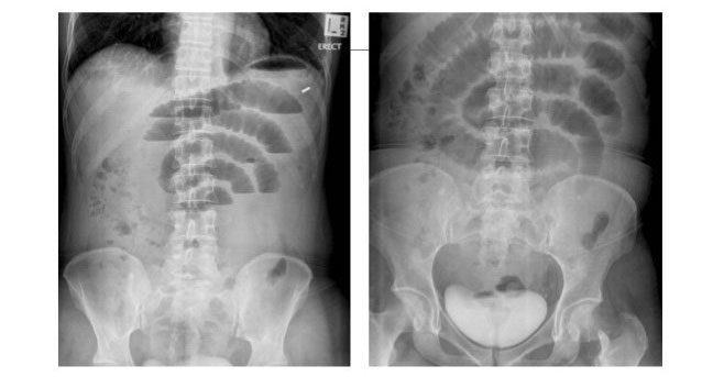 X-ray helps diagnose small bowel obstruction