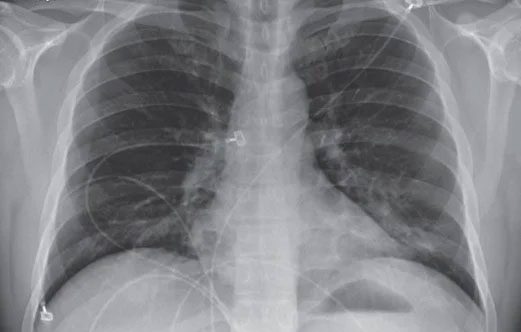 Lattice and consolidation patterns in the lung bases on the chest X-ray of a Covid-19 patient.