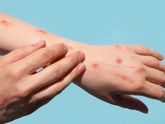 Symptoms of monkeypox infection