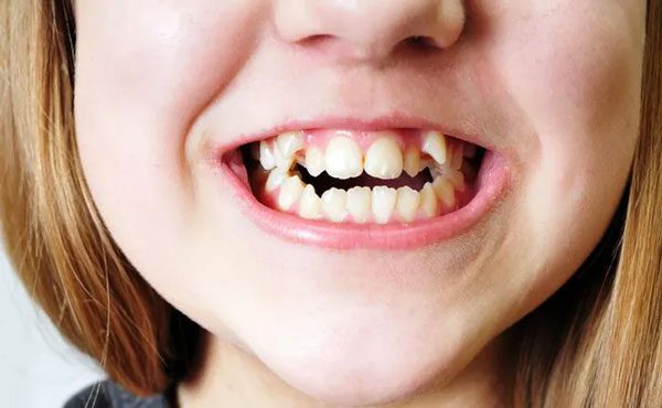Crooked Teeth