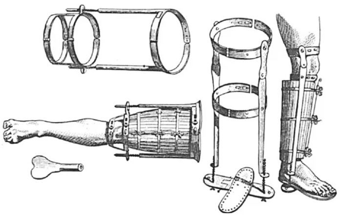 Various forms of wooden splints used for bandaging injured limbs have been utilized since ancient times to the present.