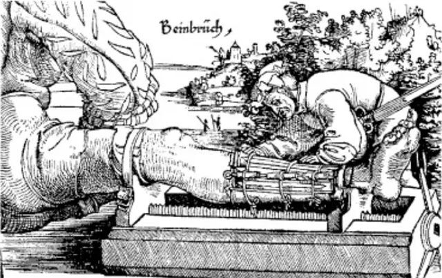Illustration of using wooden splints from Gersdorf (1517).