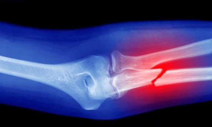 Fractures may not regenerate in some cases.