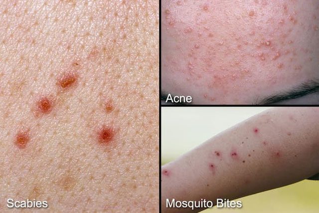 Water scabies can be confused with acne or mosquito bites...
