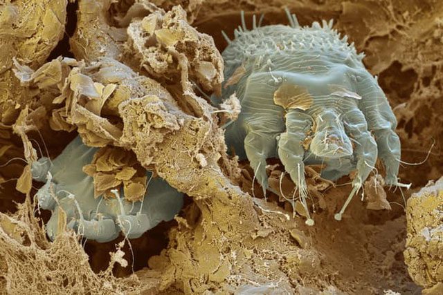 Water scabies pose a risk of outbreak in a modern city like Hanoi during the rainy season.