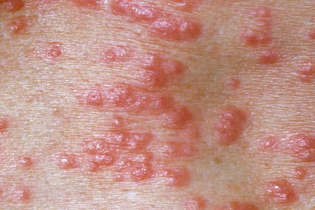 A person experiencing water scabies for the first time may take 4-6 weeks for symptoms to appear.