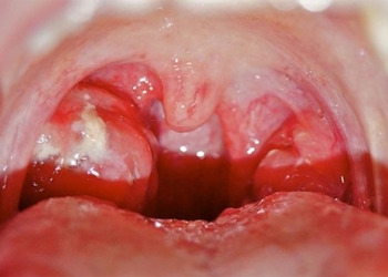 golden rules to keep children safe from throat infection 120881