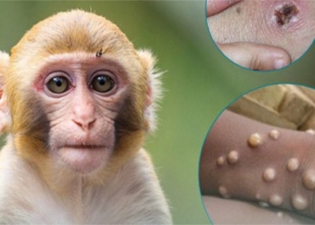 guide to differentiating symptoms of seasonal allergy vs hand foot and mouth disease and herpes simplex 122133