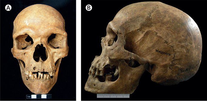 Ancient skeletons have helped scientists make significant advances in evolutionary medicine research