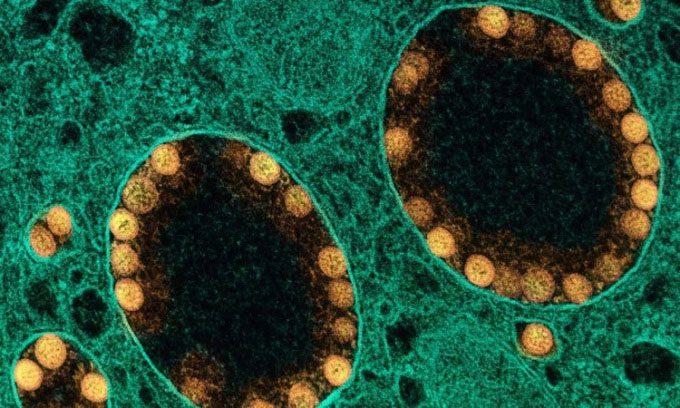 Yellow nCoV virus particles inside the membrane-binding vesicles of epithelial cells.
