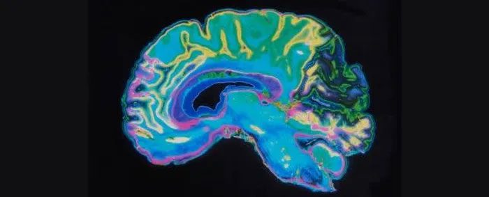 MRI image of the brain.