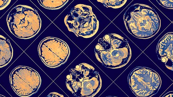 MRI scan showing reduced cortical volume in volunteers.