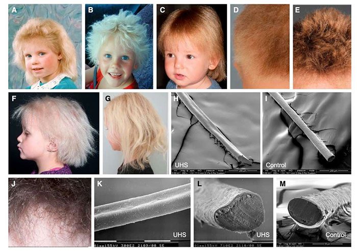 Children with uncombable hair syndrome will return to normal as they mature