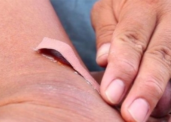 how to handle wounds with risk of infection in children 124272