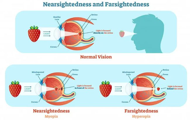 Effects of visual defects