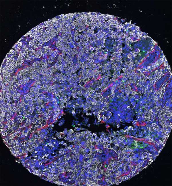 Microscopic image of a tumor in lung cancer