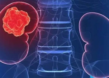 kidney cancer causes symptoms and treatment 123933