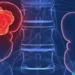 kidney cancer causes symptoms and treatment 123933