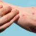 medical waste could cause virus outbreaks during the rainy season 120942