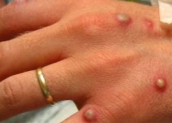 ministry of health issued guidelines for diagnosis treatment and prevention of seasonal flu 122034