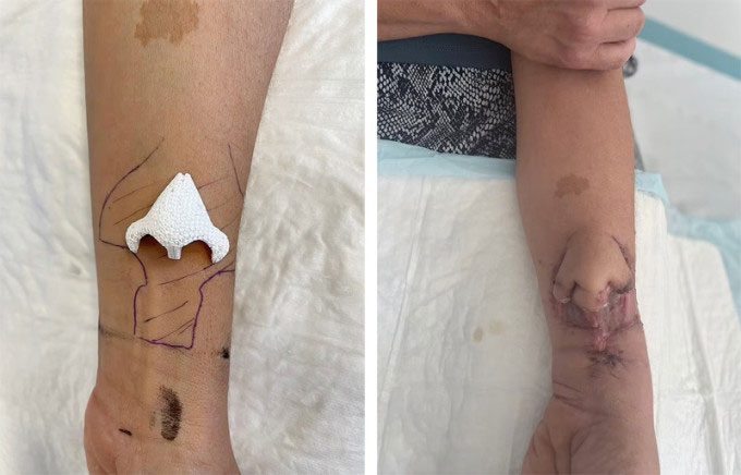 Image of the prosthetic nose cultivated on the patient's forearm.