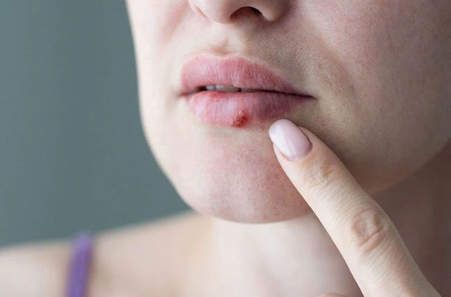 Herpes virus can cause painful sores and blisters on or around the mouth.