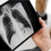 new discovery on the cause of lung cancer 122887