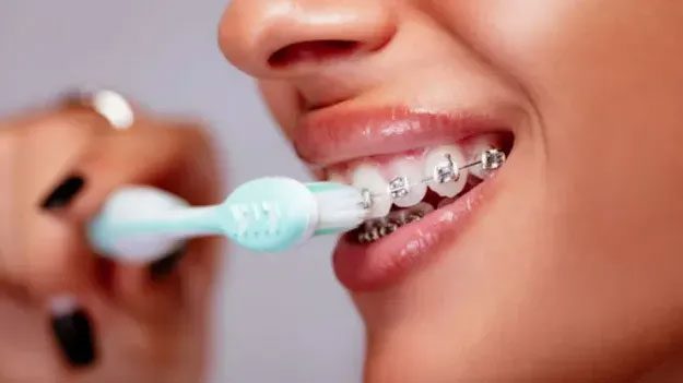 The first orthodontic device was created in the early 18th century.