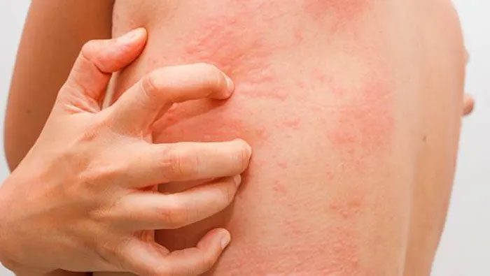 Avoid scratching or vigorous rubbing of the skin.