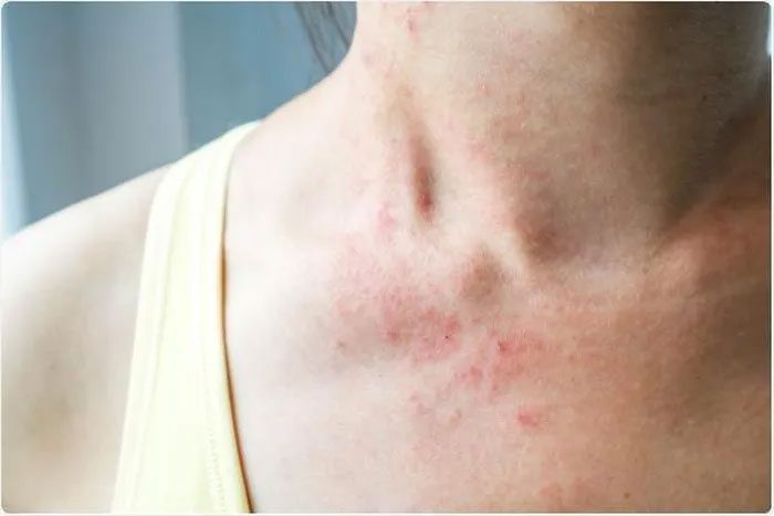 Most post-Covid-19 cases experience urticaria symptoms.
