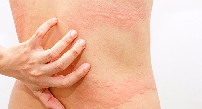 Large hives that are swollen and red.