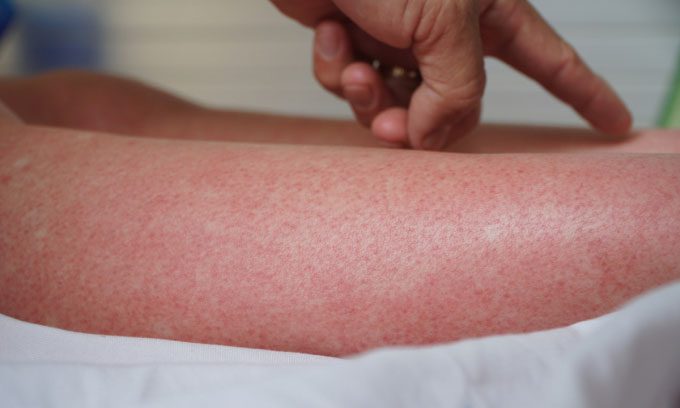 Petechiae on the legs of a female patient with dengue fever