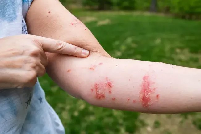 Rash Condition from Touching Poison Ivy.