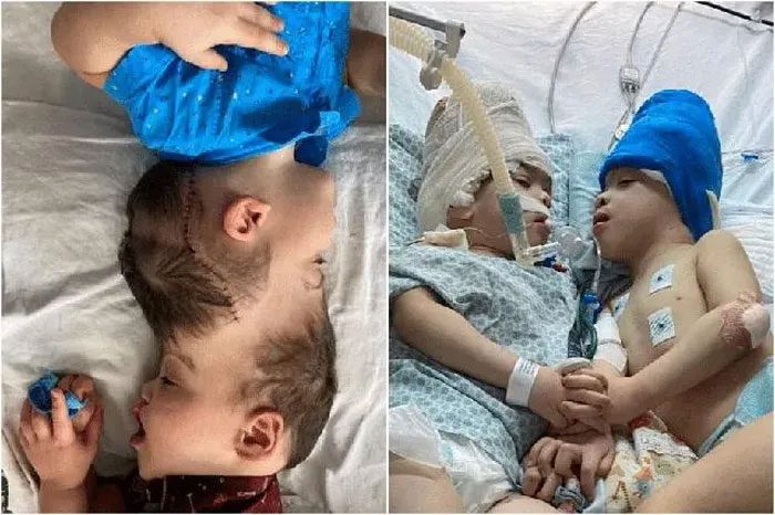 This is one of the most complex separation surgeries ever performed.