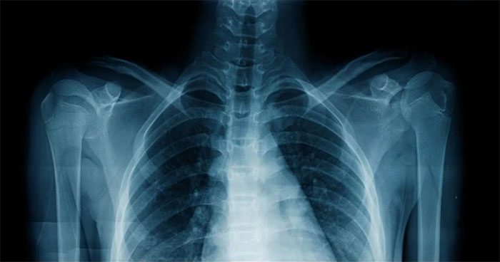 AI can accurately predict a patient's race based solely on their X-ray